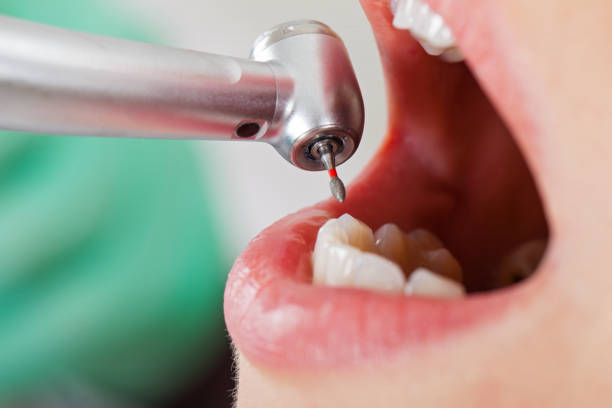 Best Emergency Treatment for Dental Infections or Abscesses in Sunnyslope, WA